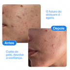 Zeracne - Spray aerosol antiacne