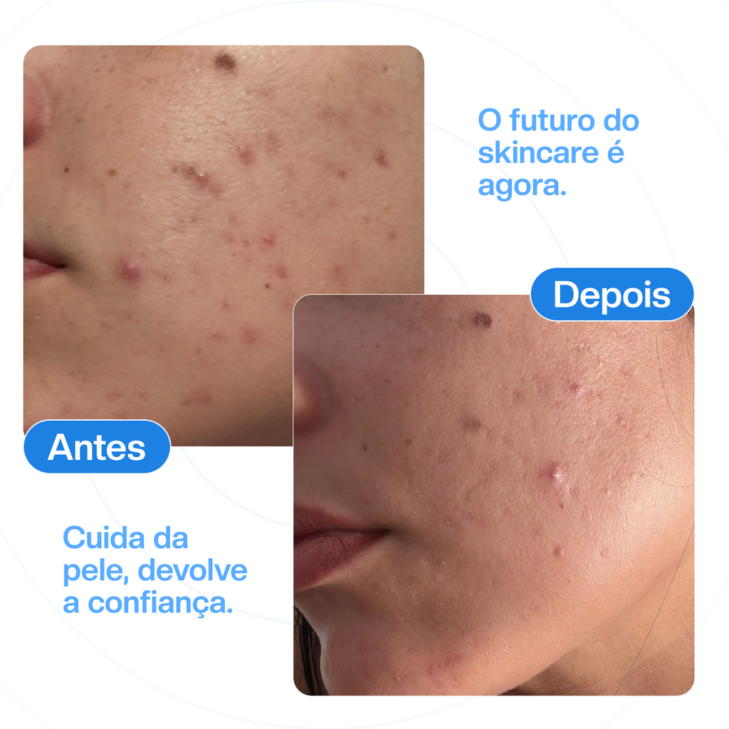 Kit Zeracne - Spray aerosol antiacne - Tratamento completo - 3 unidades